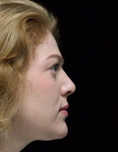 Beverly Hills Rhinoplasty Before & After Gallery - Patient 675227 - Image 2 Dr. Deepak Raj Dugar