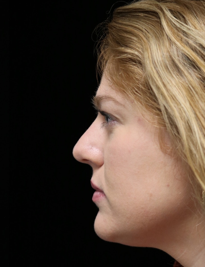 Beverly Hills Rhinoplasty Before & After Gallery - Patient 675227 - Image 5 Dr. Deepak Raj Dugar
