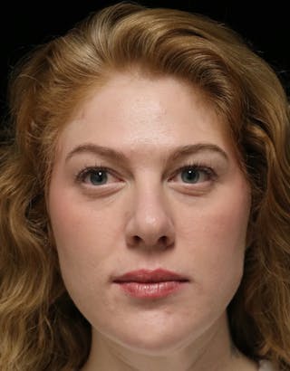 Beverly Hills Rhinoplasty Before & After Gallery - Patient 675227 - Image 10 Dr. Deepak Raj Dugar