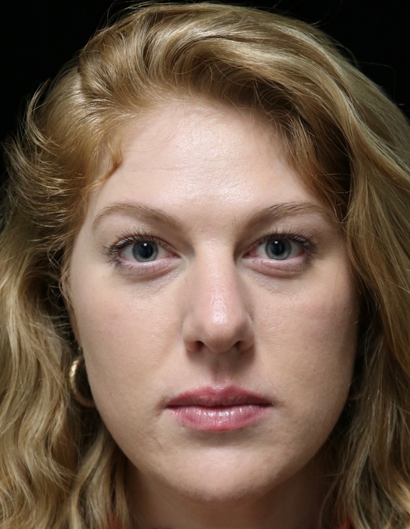 Beverly Hills Rhinoplasty Before & After Gallery - Patient 675227 - Image 9 Dr. Deepak Raj Dugar