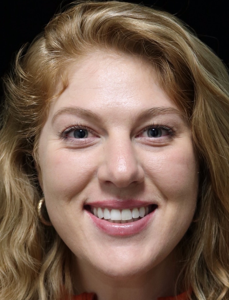 Beverly Hills Rhinoplasty Before & After Gallery - Patient 675227 - Image 11 Dr. Deepak Raj Dugar