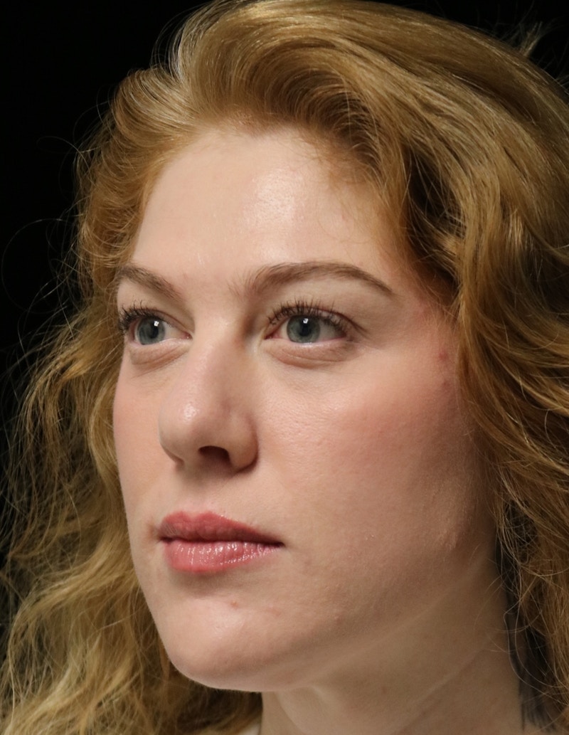 Beverly Hills Rhinoplasty Before & After Gallery - Patient 675227 - Image 8 Dr. Deepak Raj Dugar