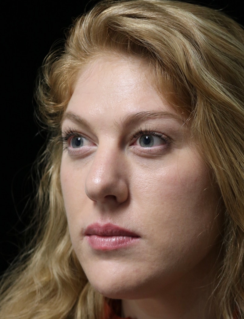 Beverly Hills Rhinoplasty Before & After Gallery - Patient 675227 - Image 7 Dr. Deepak Raj Dugar