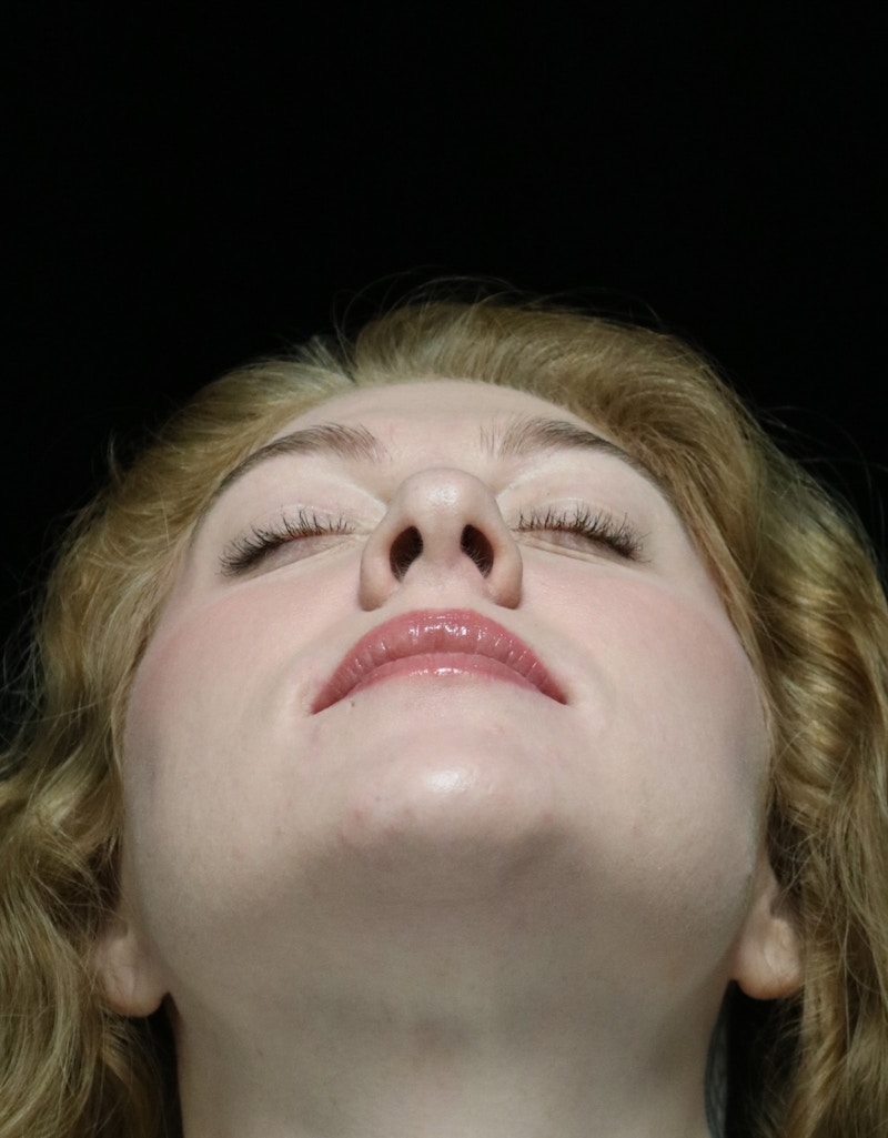 Beverly Hills Rhinoplasty Before & After Gallery - Patient 675227 - Image 14 Dr. Deepak Raj Dugar