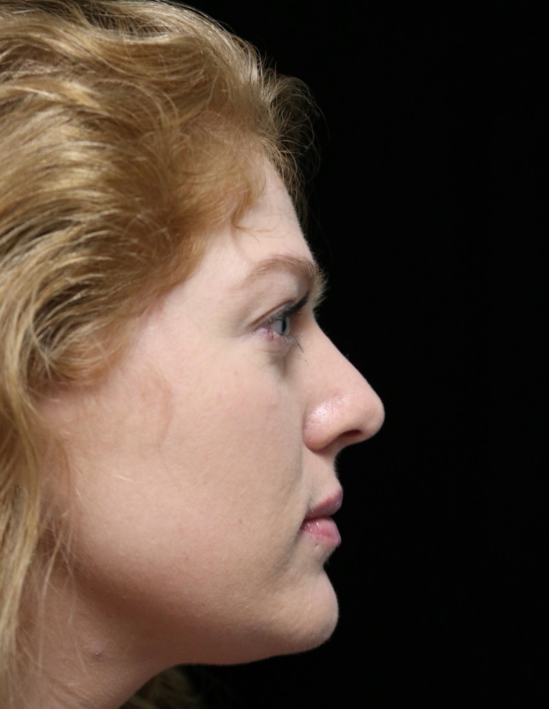 Beverly Hills Rhinoplasty Before & After Gallery - Patient 675227 - Image 1 Dr. Deepak Raj Dugar