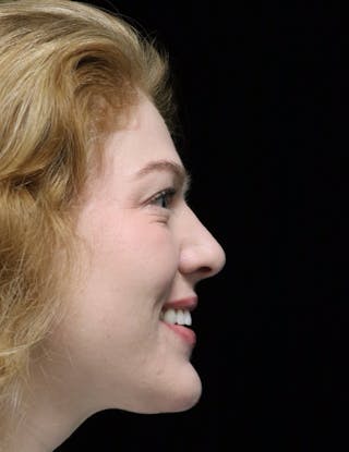 Beverly Hills Rhinoplasty Before & After Gallery - Patient 675227 - Image 4 Dr. Deepak Raj Dugar