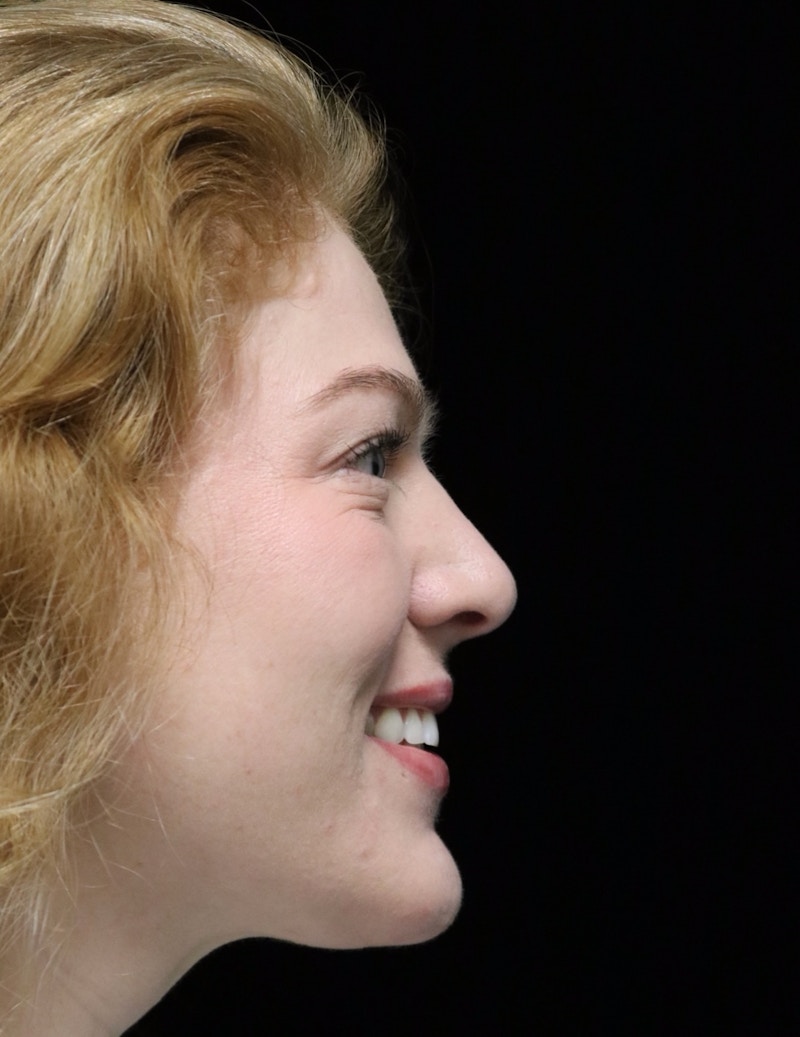 Beverly Hills Rhinoplasty Before & After Gallery - Patient 675227 - Image 4 Dr. Deepak Raj Dugar