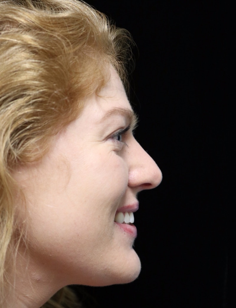 Beverly Hills Rhinoplasty Before & After Gallery - Patient 675227 - Image 3 Dr. Deepak Raj Dugar