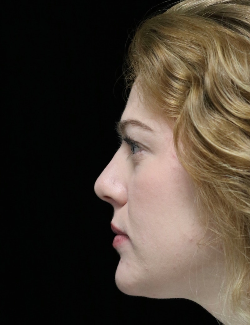 Beverly Hills Rhinoplasty Before & After Gallery - Patient 675227 - Image 6 Dr. Deepak Raj Dugar