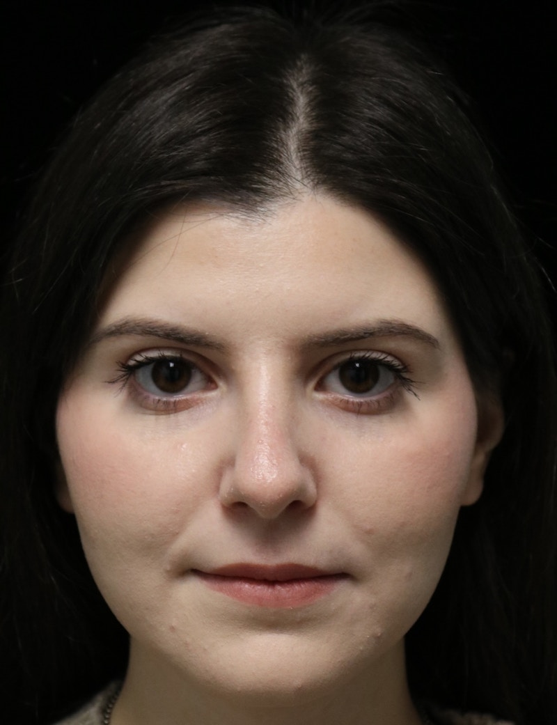 Beverly Hills Rhinoplasty Before & After Gallery - Patient 284159 - Image 10 Dr. Deepak Raj Dugar