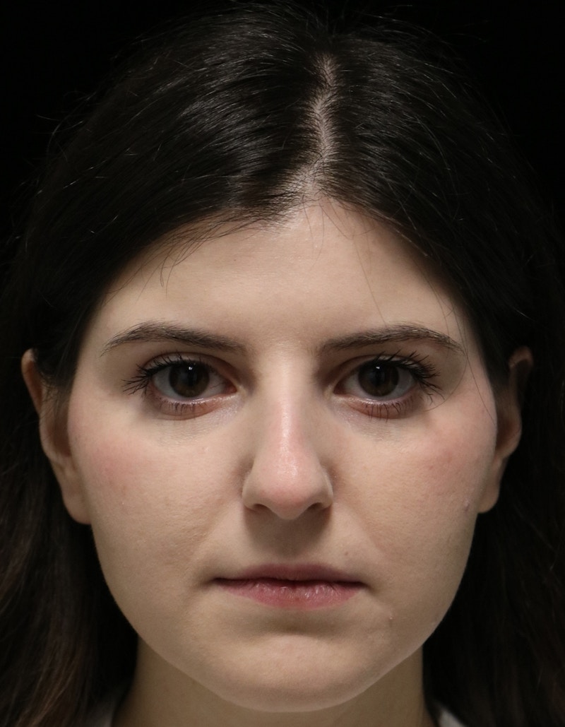 Beverly Hills Rhinoplasty Before & After Gallery - Patient 284159 - Image 9 Dr. Deepak Raj Dugar