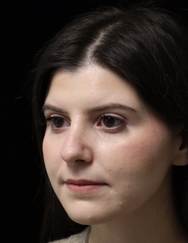 Beverly Hills Rhinoplasty Before & After Gallery - Patient 284159 - Image 8 Dr. Deepak Raj Dugar