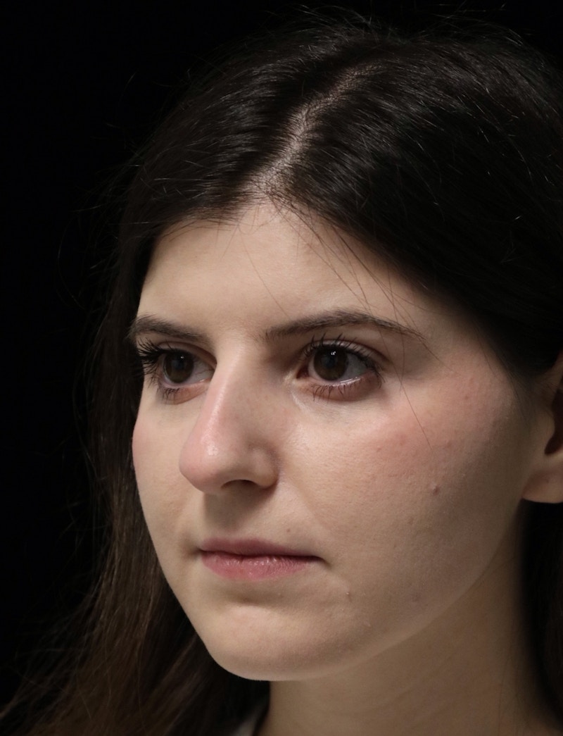 Beverly Hills Rhinoplasty Before & After Gallery - Patient 284159 - Image 7 Dr. Deepak Raj Dugar