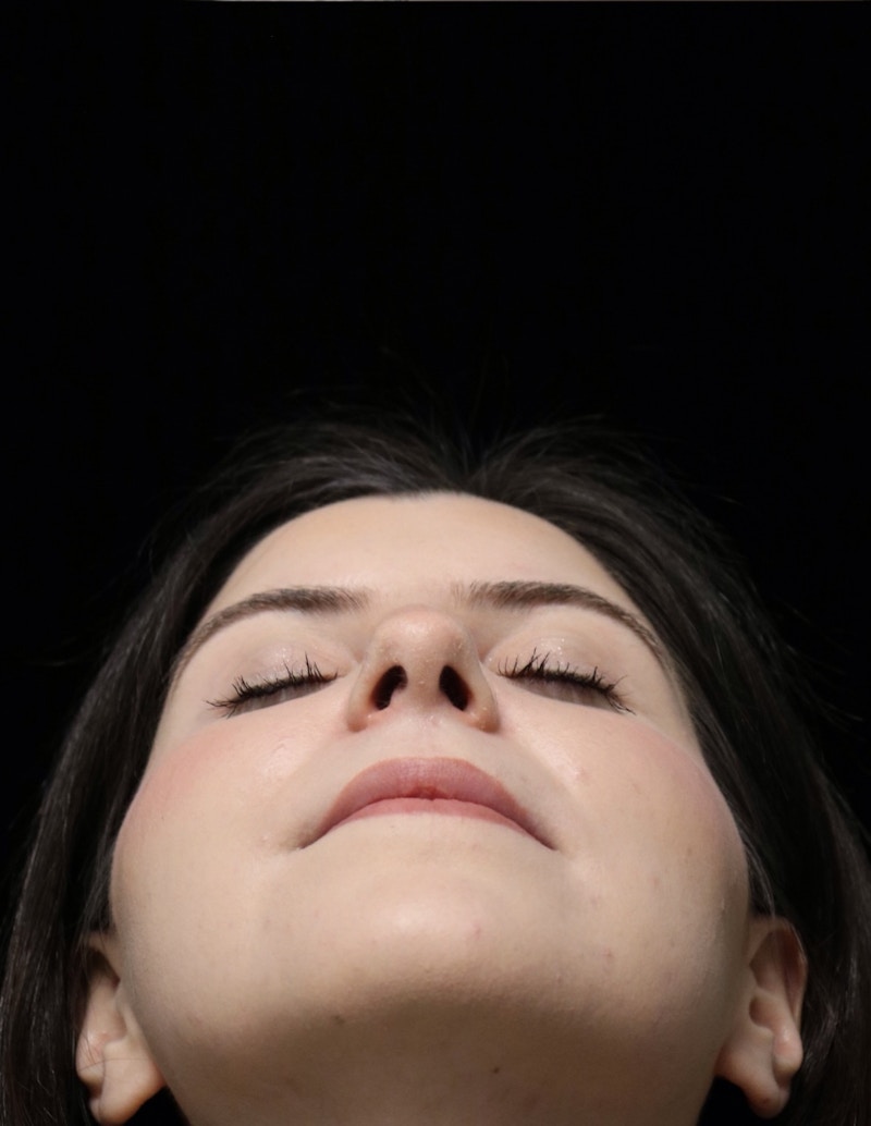 Beverly Hills Rhinoplasty Before & After Gallery - Patient 284159 - Image 14 Dr. Deepak Raj Dugar