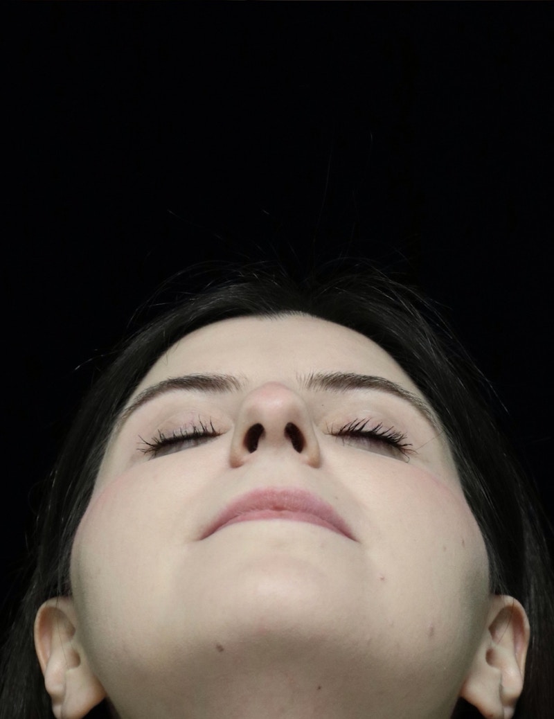 Beverly Hills Rhinoplasty Before & After Gallery - Patient 284159 - Image 13 Dr. Deepak Raj Dugar