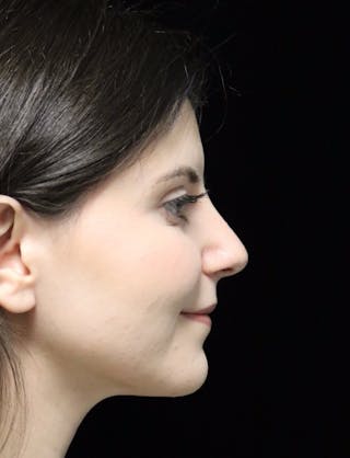 Beverly Hills Rhinoplasty Before & After Gallery - Patient 284159 - Image 4 Dr. Deepak Raj Dugar