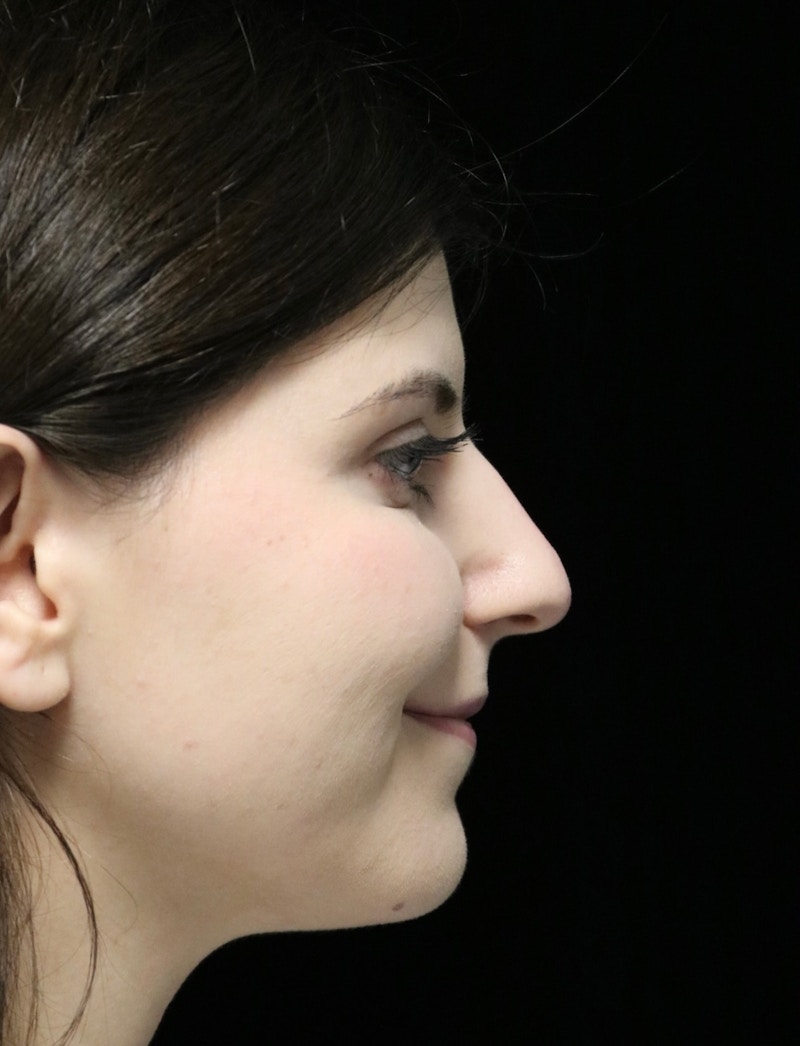 Beverly Hills Rhinoplasty Before & After Gallery - Patient 284159 - Image 3 Dr. Deepak Raj Dugar