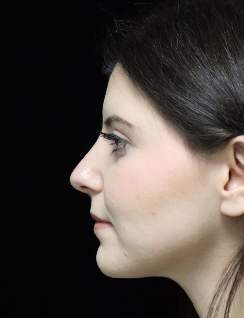 Beverly Hills Rhinoplasty Before & After Gallery - Patient 284159 - Image 6 Dr. Deepak Raj Dugar