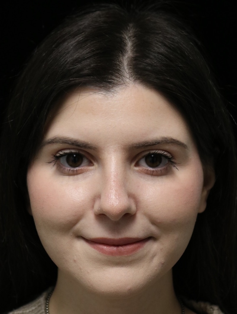 Beverly Hills Rhinoplasty Before & After Gallery - Patient 284159 - Image 12 Dr. Deepak Raj Dugar