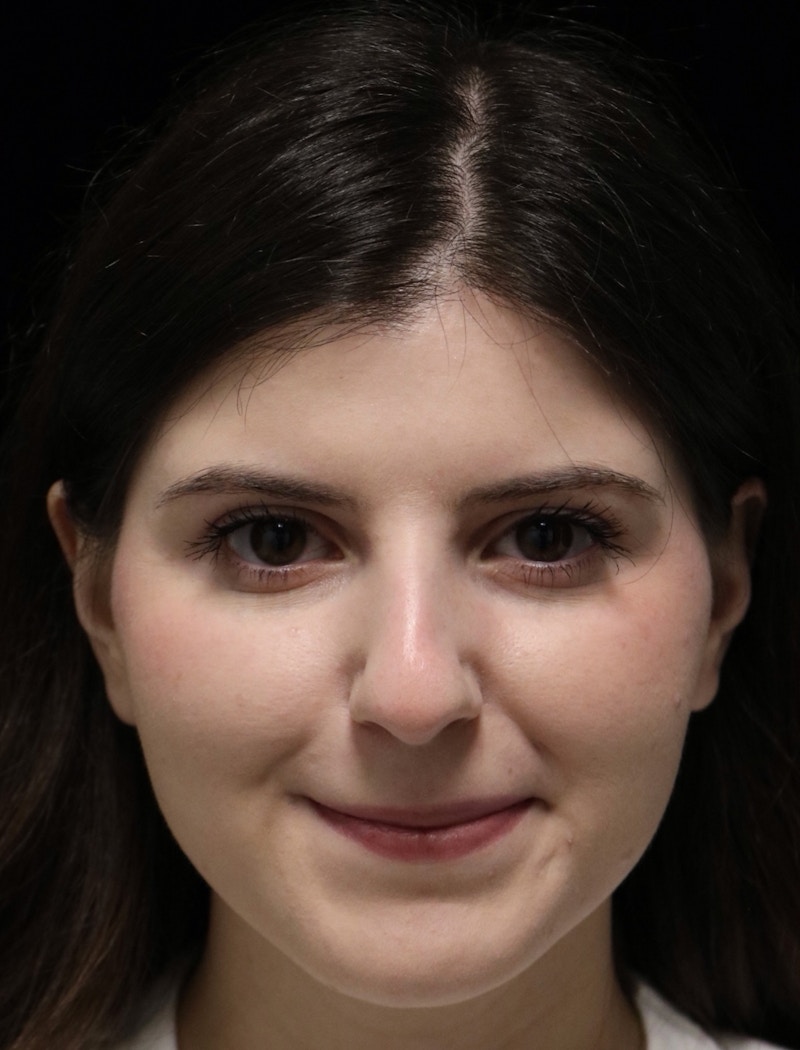 Beverly Hills Rhinoplasty Before & After Gallery - Patient 284159 - Image 11 Dr. Deepak Raj Dugar