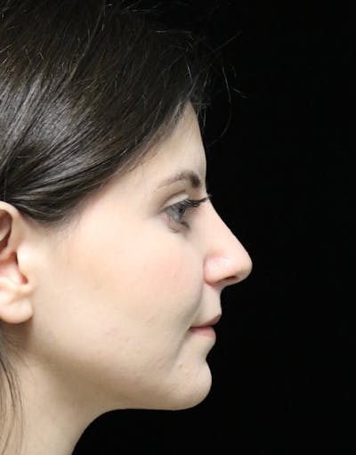 Beverly Hills Rhinoplasty Before & After Gallery - Patient 284159 - Image 2 Dr. Deepak Raj Dugar