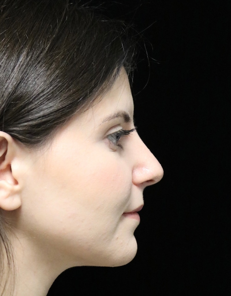 Beverly Hills Rhinoplasty Before & After Gallery - Patient 284159 - Image 2 Dr. Deepak Raj Dugar