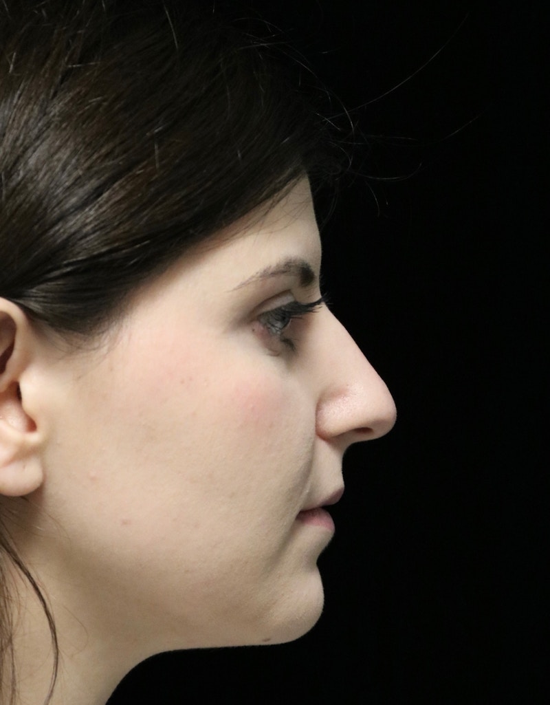 Beverly Hills Rhinoplasty Before & After Gallery - Patient 284159 - Image 1 Dr. Deepak Raj Dugar