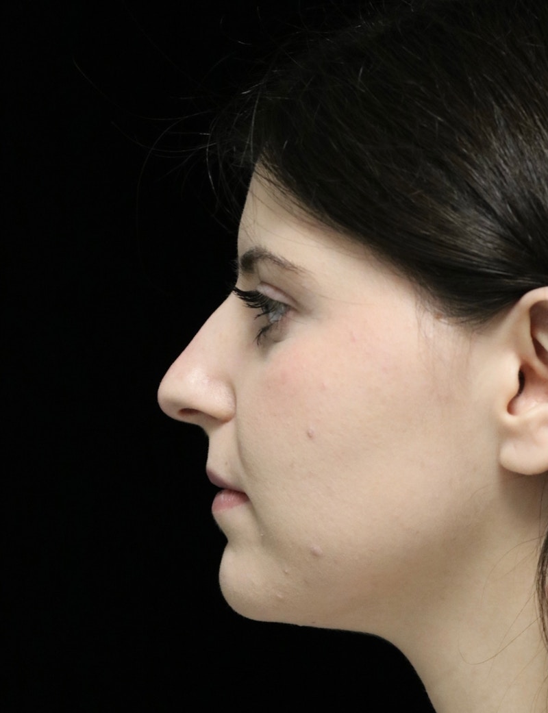 Beverly Hills Rhinoplasty Before & After Gallery - Patient 284159 - Image 5 Dr. Deepak Raj Dugar