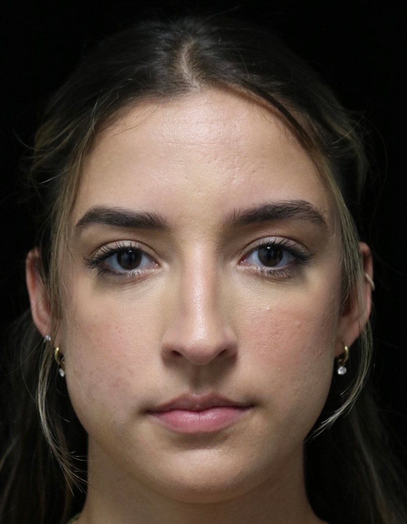 Beverly Hills Rhinoplasty Before & After Gallery - Patient 383370 - Image 9 Dr. Deepak Raj Dugar