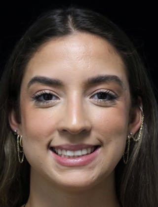 Beverly Hills Rhinoplasty Before & After Gallery - Patient 383370 - Image 12 Dr. Deepak Raj Dugar