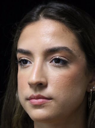 Beverly Hills Rhinoplasty Before & After Gallery - Patient 383370 - Image 8 Dr. Deepak Raj Dugar