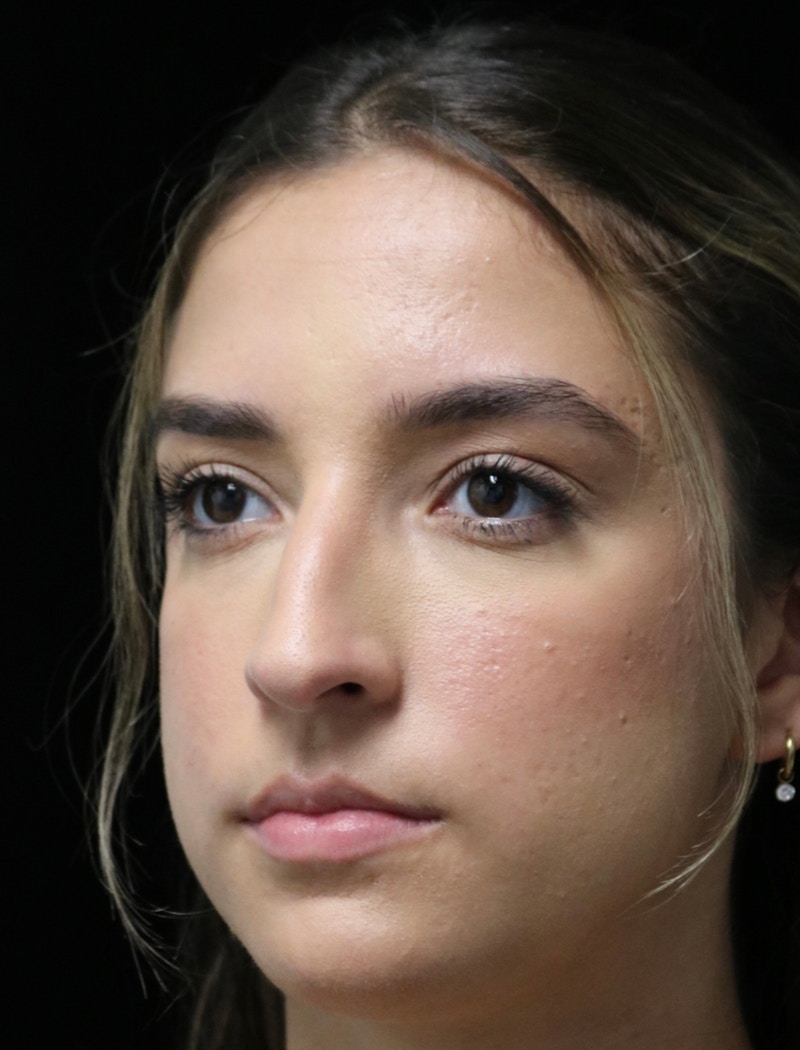 Beverly Hills Rhinoplasty Before & After Gallery - Patient 383370 - Image 7 Dr. Deepak Raj Dugar