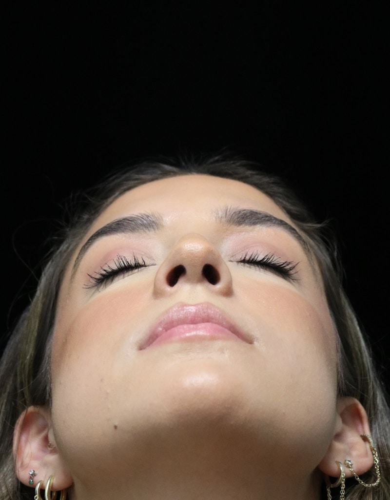 Beverly Hills Rhinoplasty Before & After Gallery - Patient 383370 - Image 14 Dr. Deepak Raj Dugar