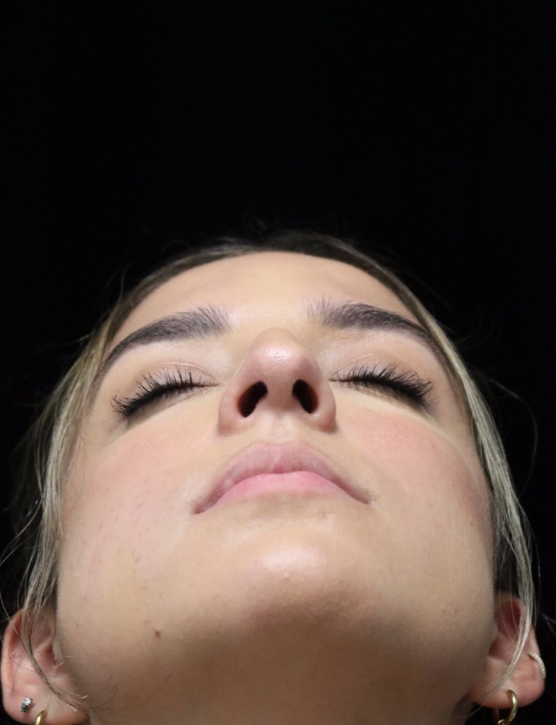 Beverly Hills Rhinoplasty Before & After Gallery - Patient 383370 - Image 13 Dr. Deepak Raj Dugar