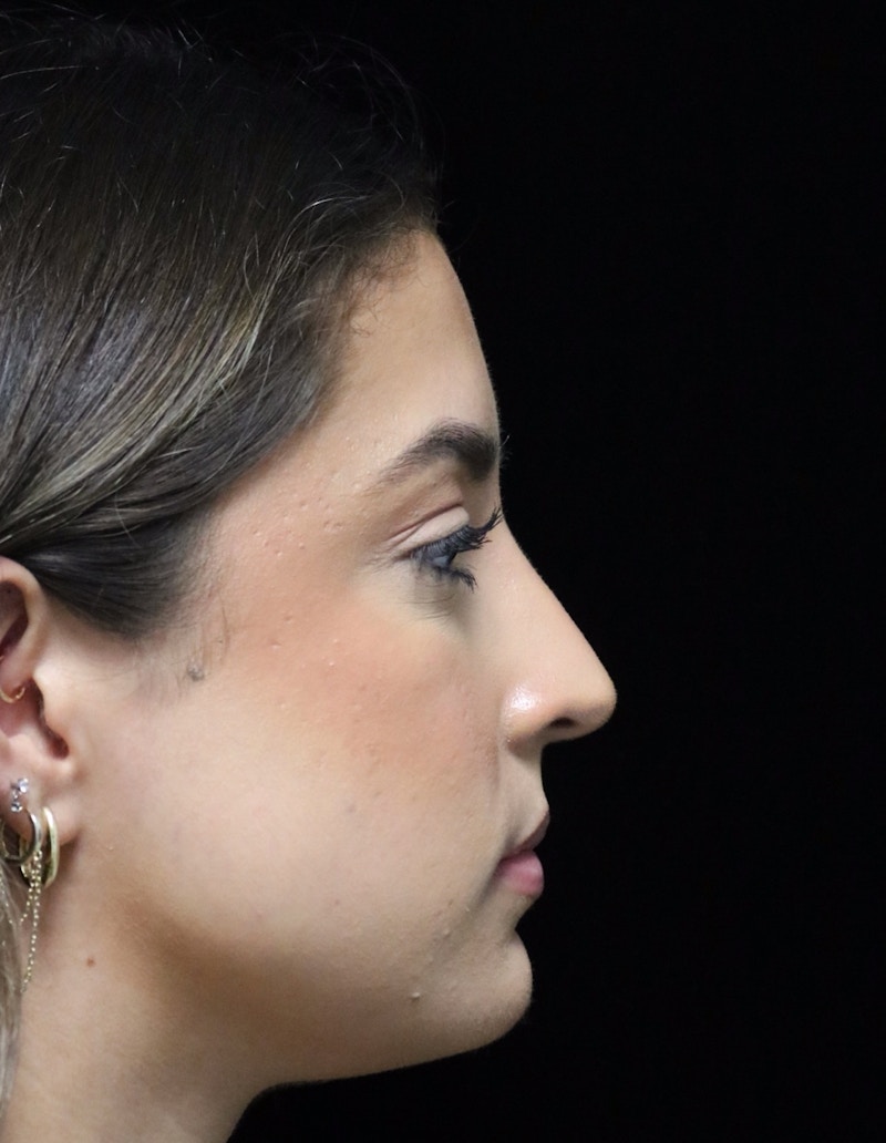 Beverly Hills Rhinoplasty Before & After Gallery - Patient 383370 - Image 2 Dr. Deepak Raj Dugar