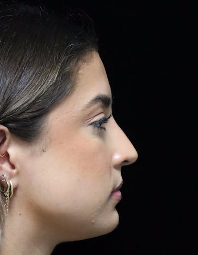 Beverly Hills Rhinoplasty Before & After Gallery - Patient 383370 - Image 2 Dr. Deepak Raj Dugar