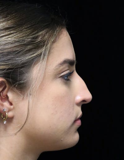 Rhinoplasty Before & After Gallery - Patient 383370 - Image 1