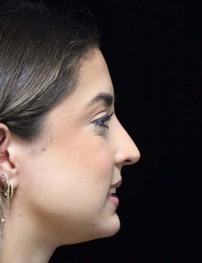 Beverly Hills Rhinoplasty Before & After Gallery - Patient 383370 - Image 4 Dr. Deepak Raj Dugar