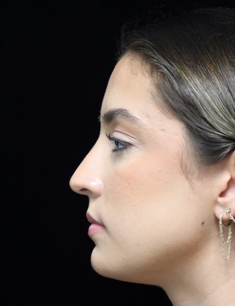 Beverly Hills Rhinoplasty Before & After Gallery - Patient 383370 - Image 6 Dr. Deepak Raj Dugar