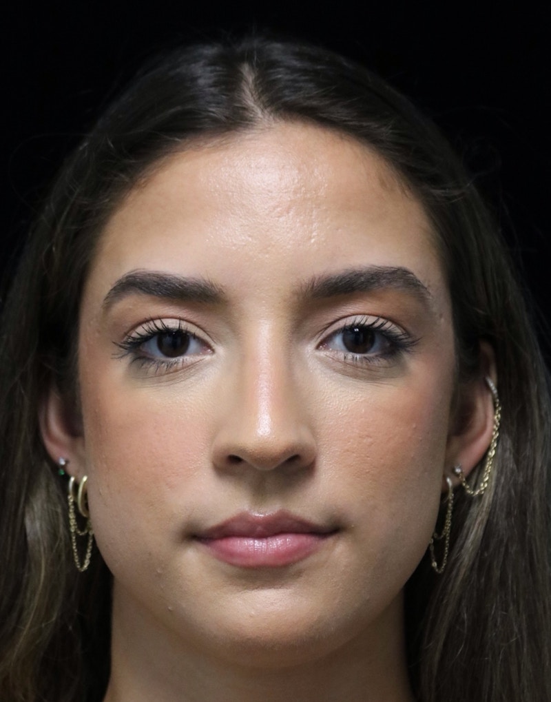 Beverly Hills Rhinoplasty Before & After Gallery - Patient 383370 - Image 10 Dr. Deepak Raj Dugar