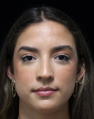 Beverly Hills Rhinoplasty Before & After Gallery - Patient 383370 - Image 10 Dr. Deepak Raj Dugar