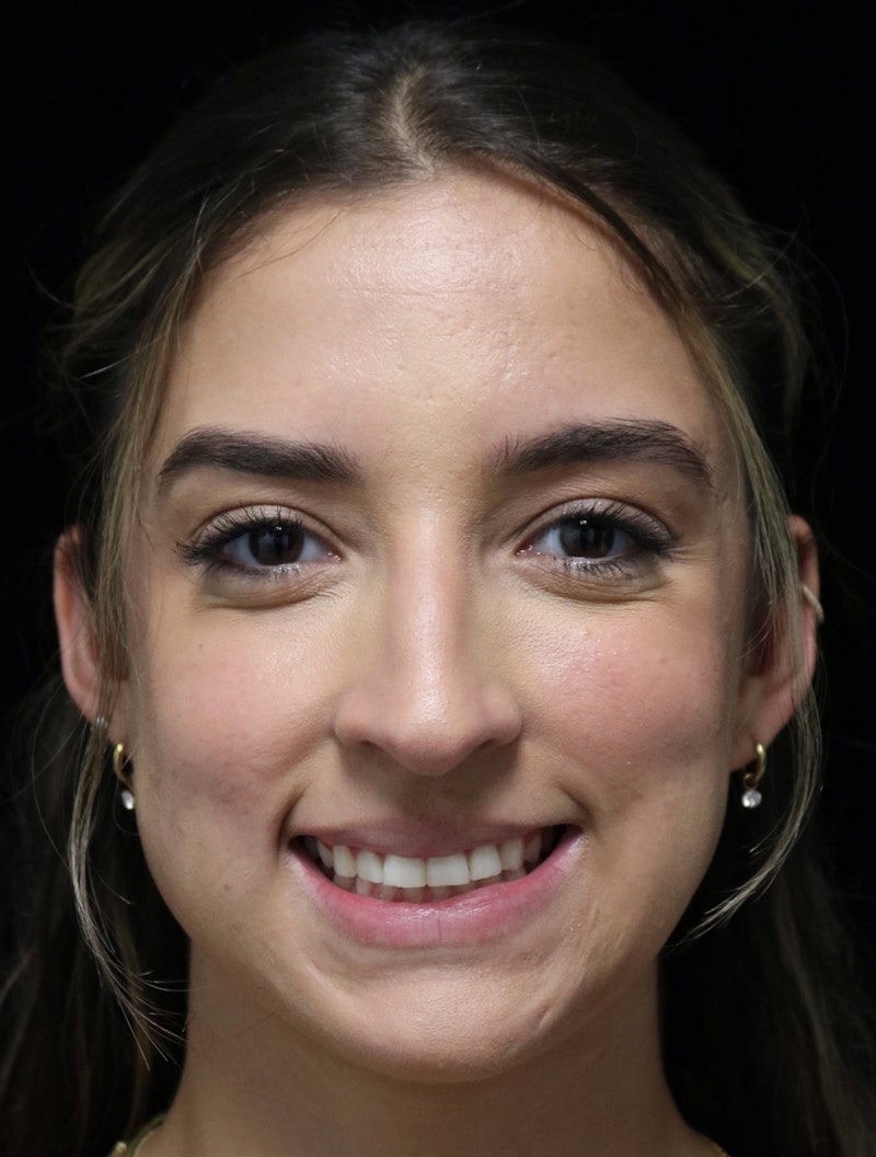 Beverly Hills Rhinoplasty Before & After Gallery - Patient 383370 - Image 11 Dr. Deepak Raj Dugar