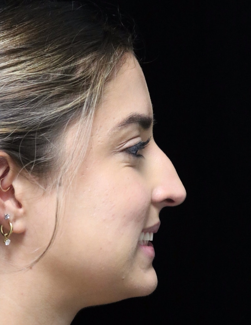 Beverly Hills Rhinoplasty Before & After Gallery - Patient 383370 - Image 3 Dr. Deepak Raj Dugar