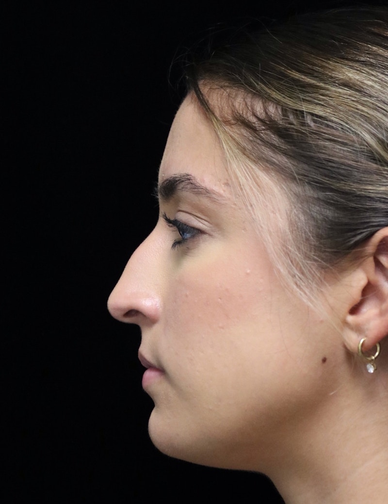 Beverly Hills Rhinoplasty Before & After Gallery - Patient 383370 - Image 5 Dr. Deepak Raj Dugar