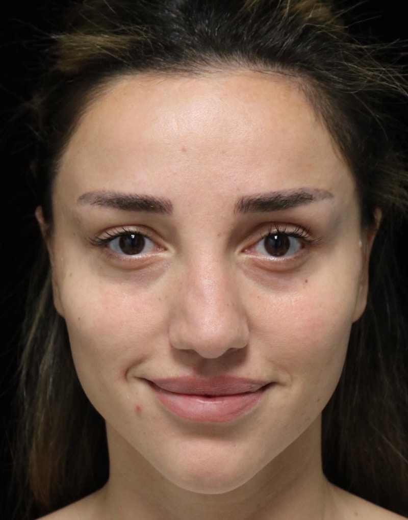 Beverly Hills Rhinoplasty Before & After Gallery - Patient 254674 - Image 9 Dr. Deepak Raj Dugar