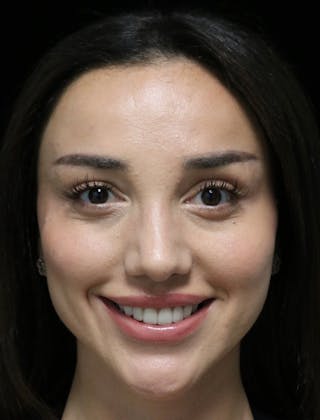 Beverly Hills Rhinoplasty Before & After Gallery - Patient 254674 - Image 12 Dr. Deepak Raj Dugar