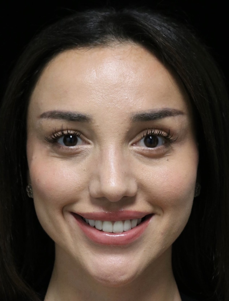 Beverly Hills Rhinoplasty Before & After Gallery - Patient 254674 - Image 12 Dr. Deepak Raj Dugar