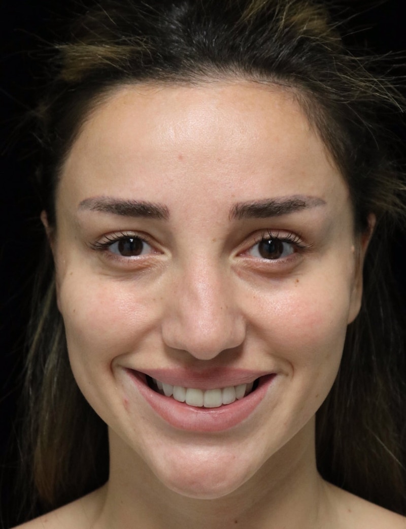 Beverly Hills Rhinoplasty Before & After Gallery - Patient 254674 - Image 11 Dr. Deepak Raj Dugar