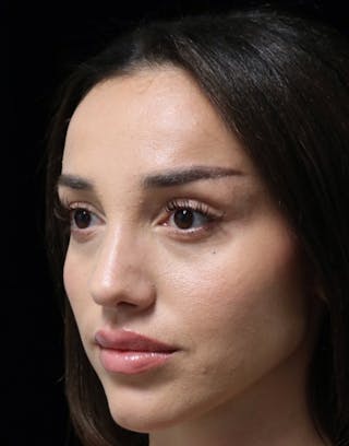 Beverly Hills Rhinoplasty Before & After Gallery - Patient 254674 - Image 8 Dr. Deepak Raj Dugar
