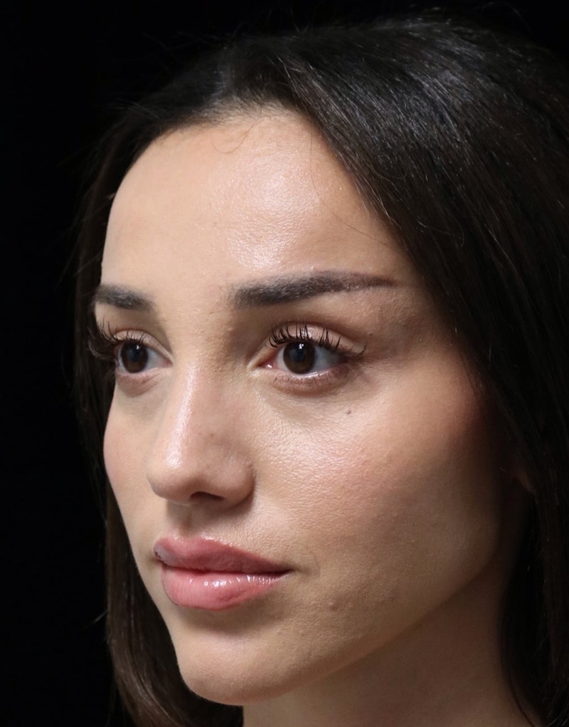 Beverly Hills Rhinoplasty Before & After Gallery - Patient 254674 - Image 8 Dr. Deepak Raj Dugar